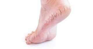 Photo of கால்களினி பித்தவெடிப்பை எப்படி சரிசெய்யலாம்